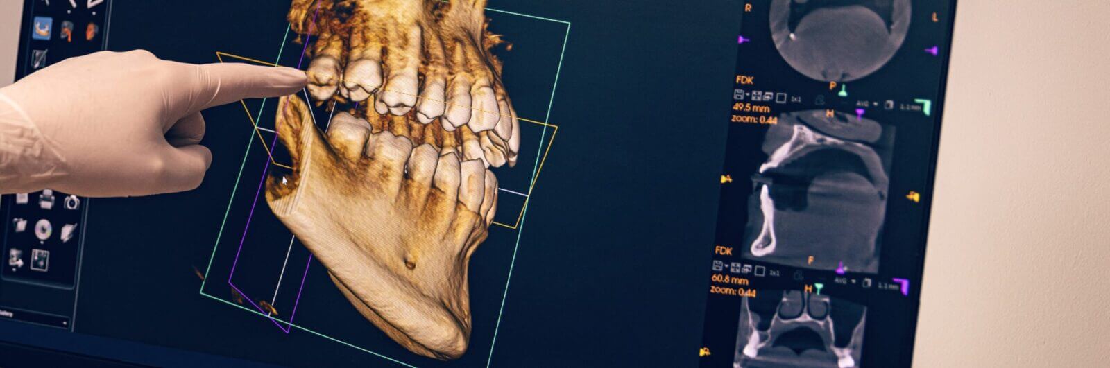 3D rendering of a jaw and teeth